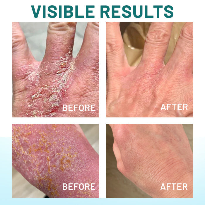 Misspone® Probiotic + B 24-7 Moisture Eczema Relief Cream